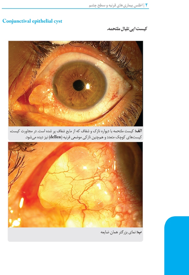 اطلس بیماری های قرنیه و سطح چشم 